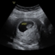 8 Week Ultrasound