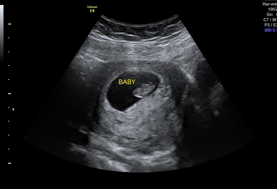 Pregnancy Verification Ultrasounds | Gender Check Ultrasound Utah